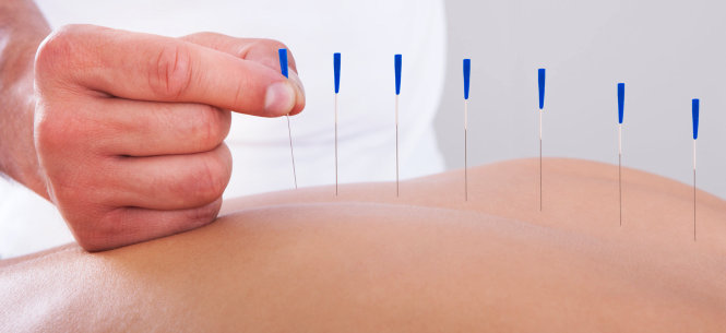blue acupuncture pins