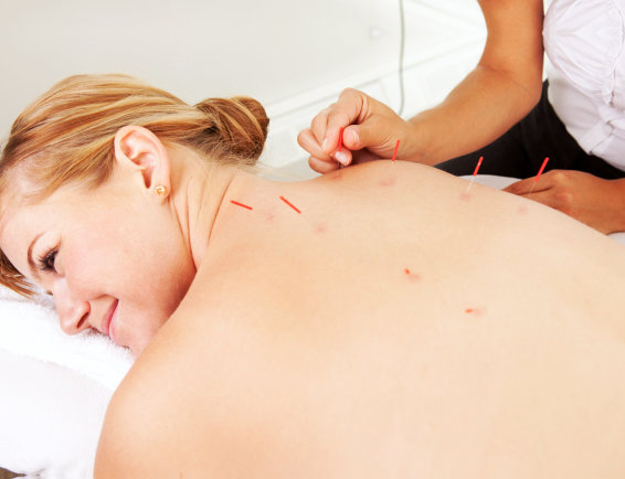 woman undergoing acupuncture