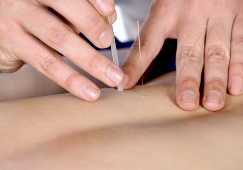 physiotherapist doing acupuncture on the back of a female patient